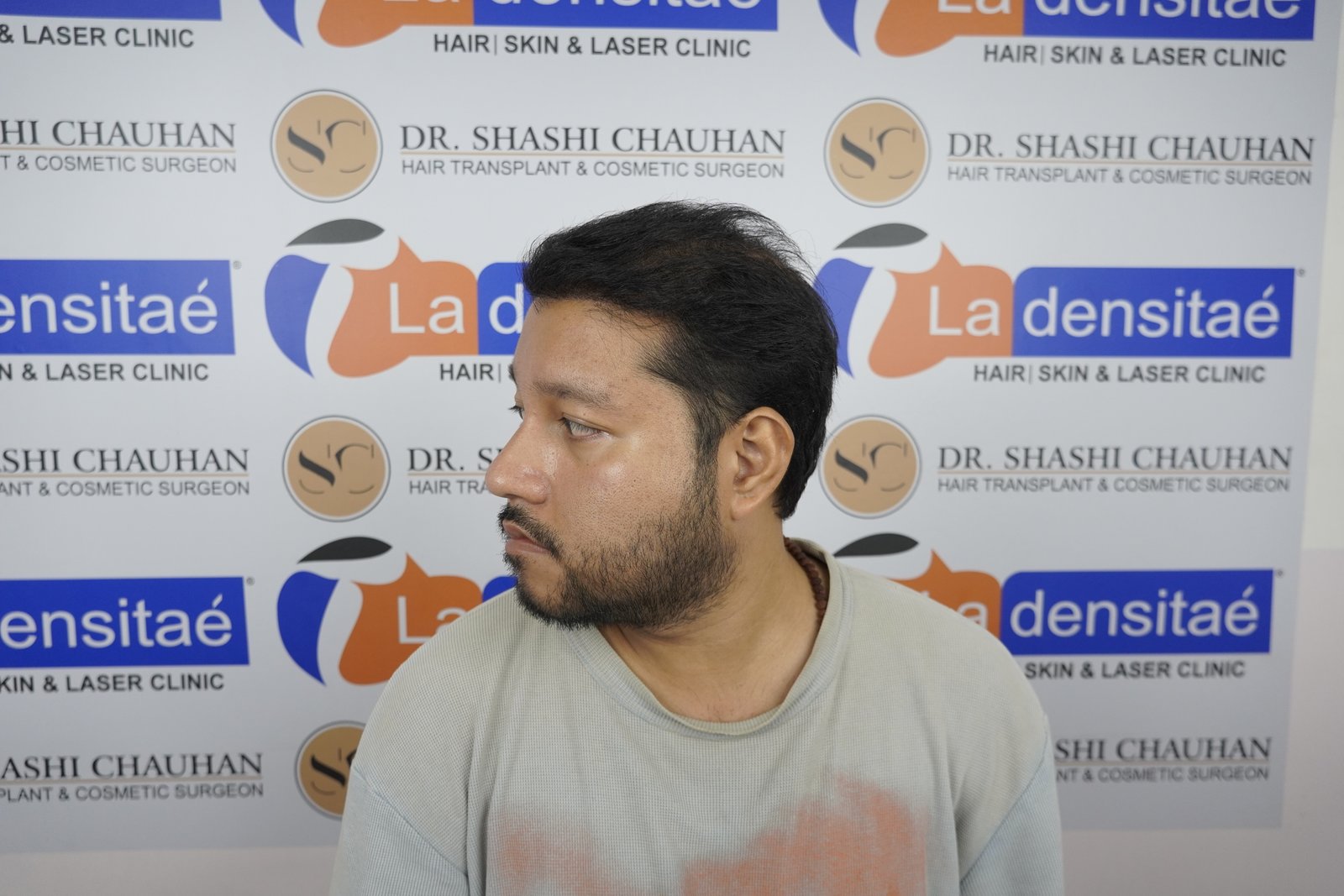 Dr. Bishal After Hair Transplant